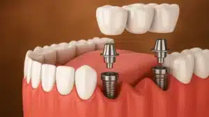3D illustration showing the components of a dental implant, including the implant post, abutment, and dental crown used to replace a missing tooth.