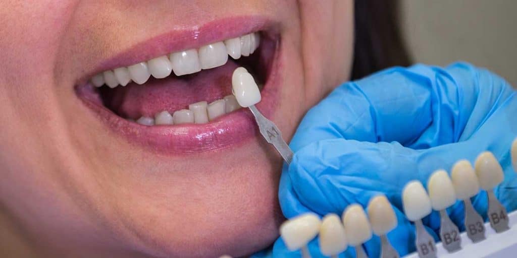 Close-up of a dentist using a tooth shade guide to match dental veneers to a patient's natural teeth for a seamless smile.